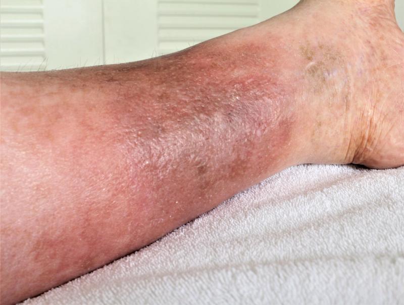 Woman's leg with chronic venous insufficiency | Credit: Adobe Stock