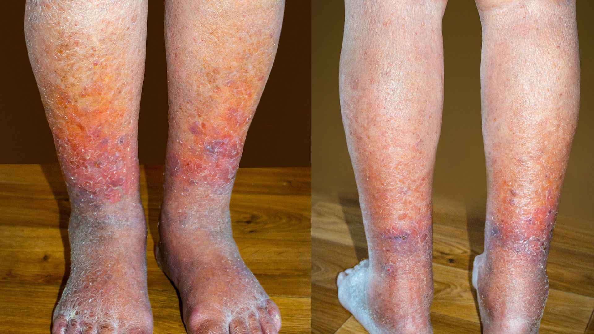 Venous Thromboembolism 