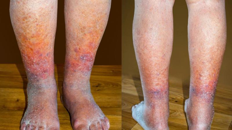 Venous Thromboembolism 