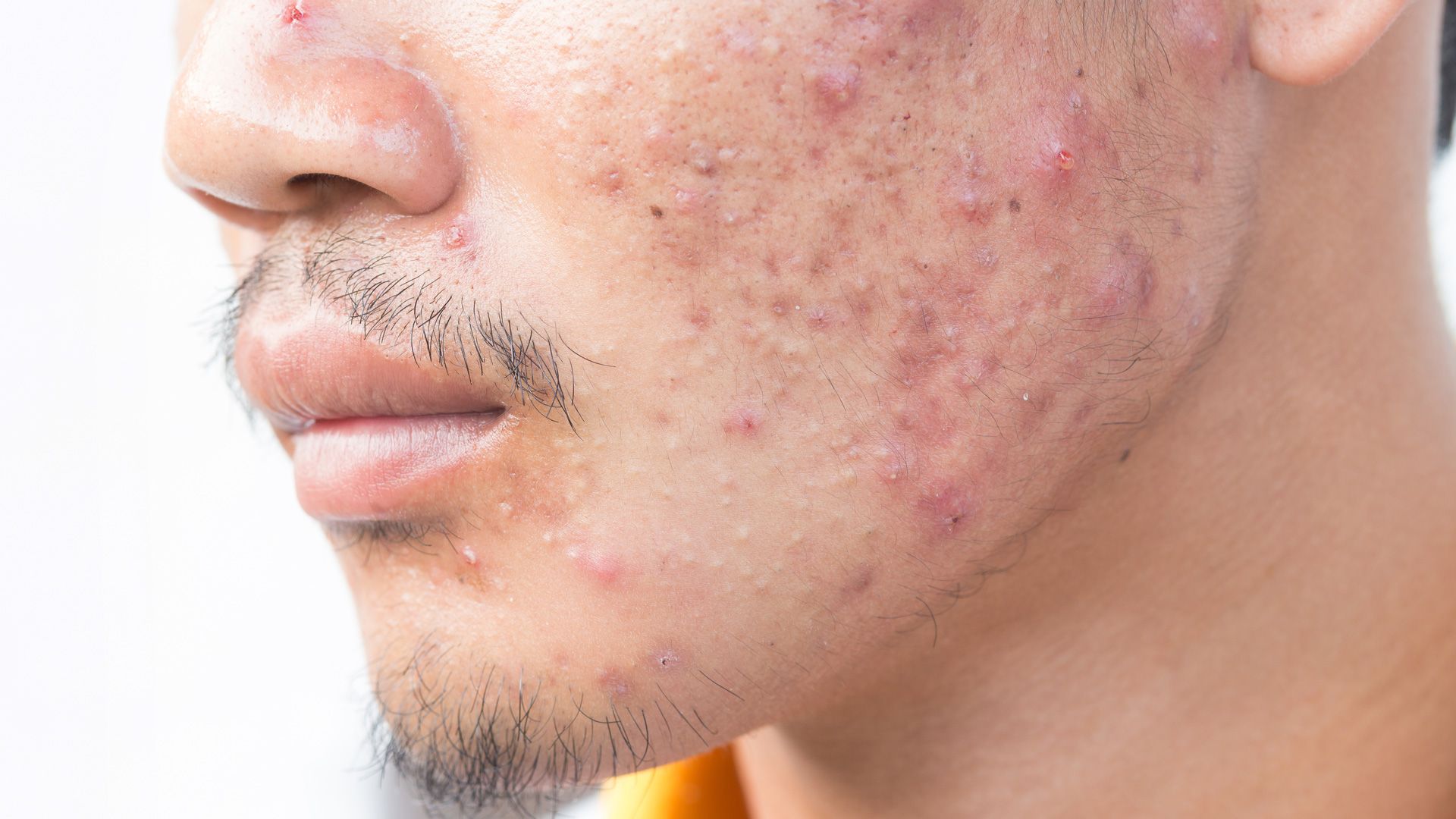 The Educated Patient - Acne