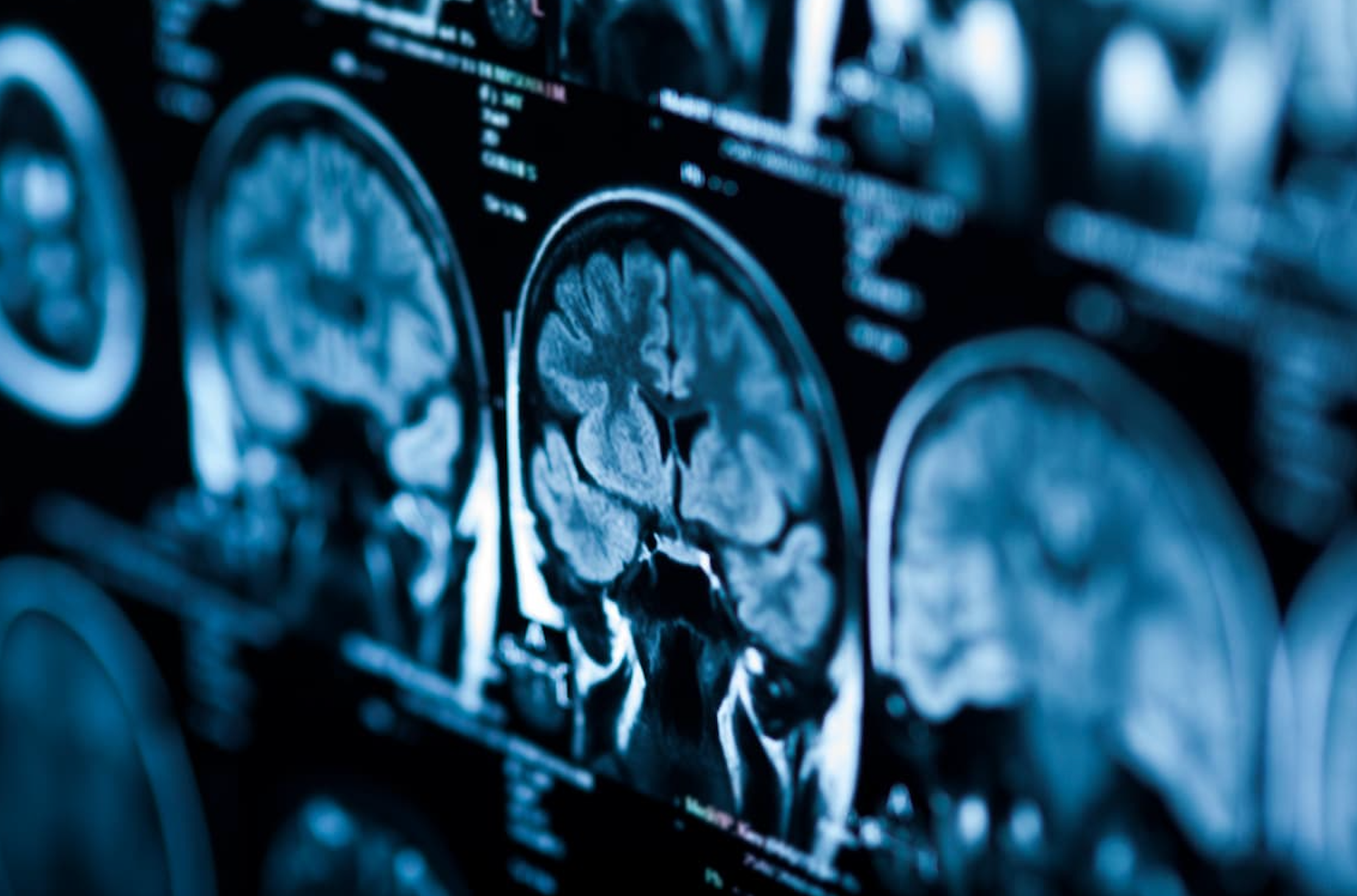 One Pill, Three Meds: A New Strategy to Prevent Repeat Stroke