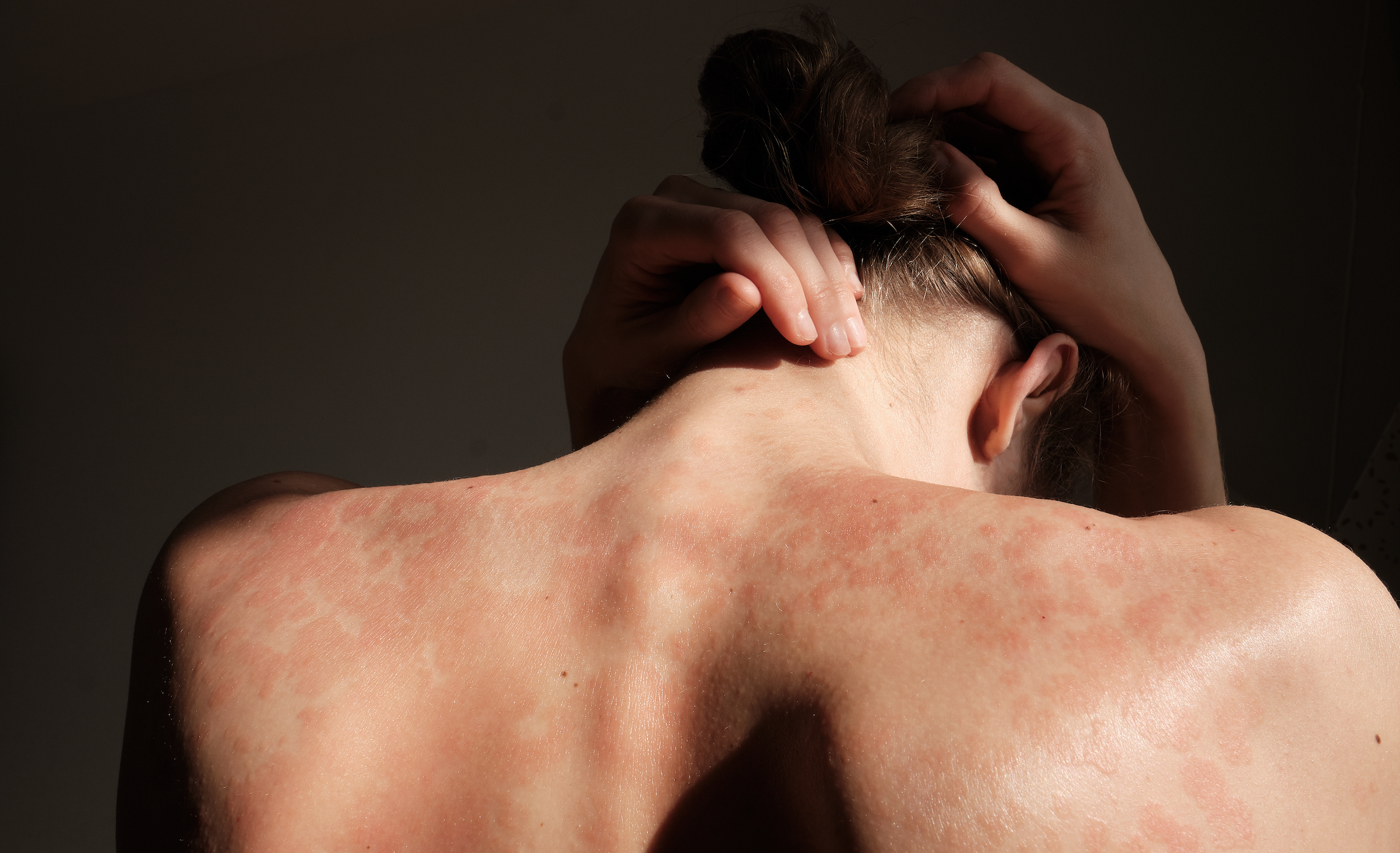 Tori Spelling’s Mission to Change the Eczema Conversation