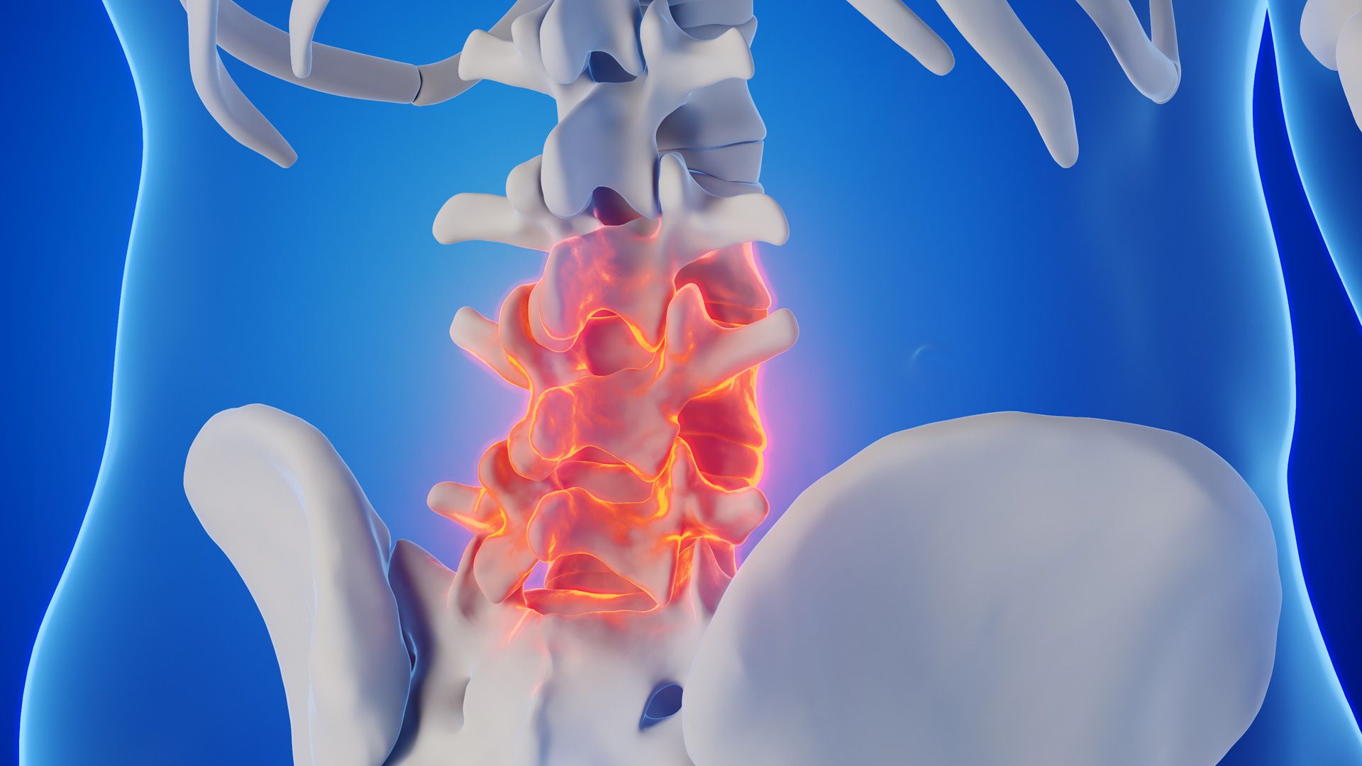 Spondyloarthritis