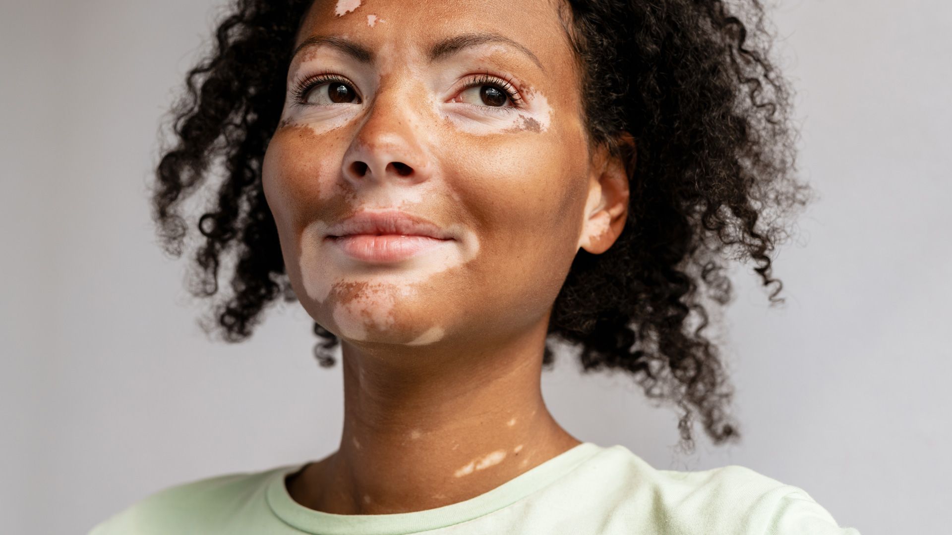 Vitiligo 