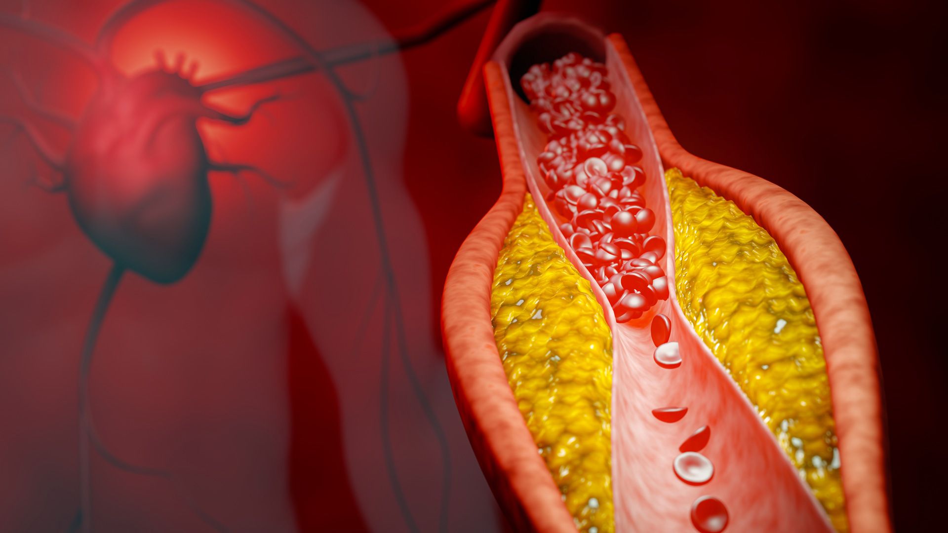 Atherosclerotic Cardiovascular Disease 