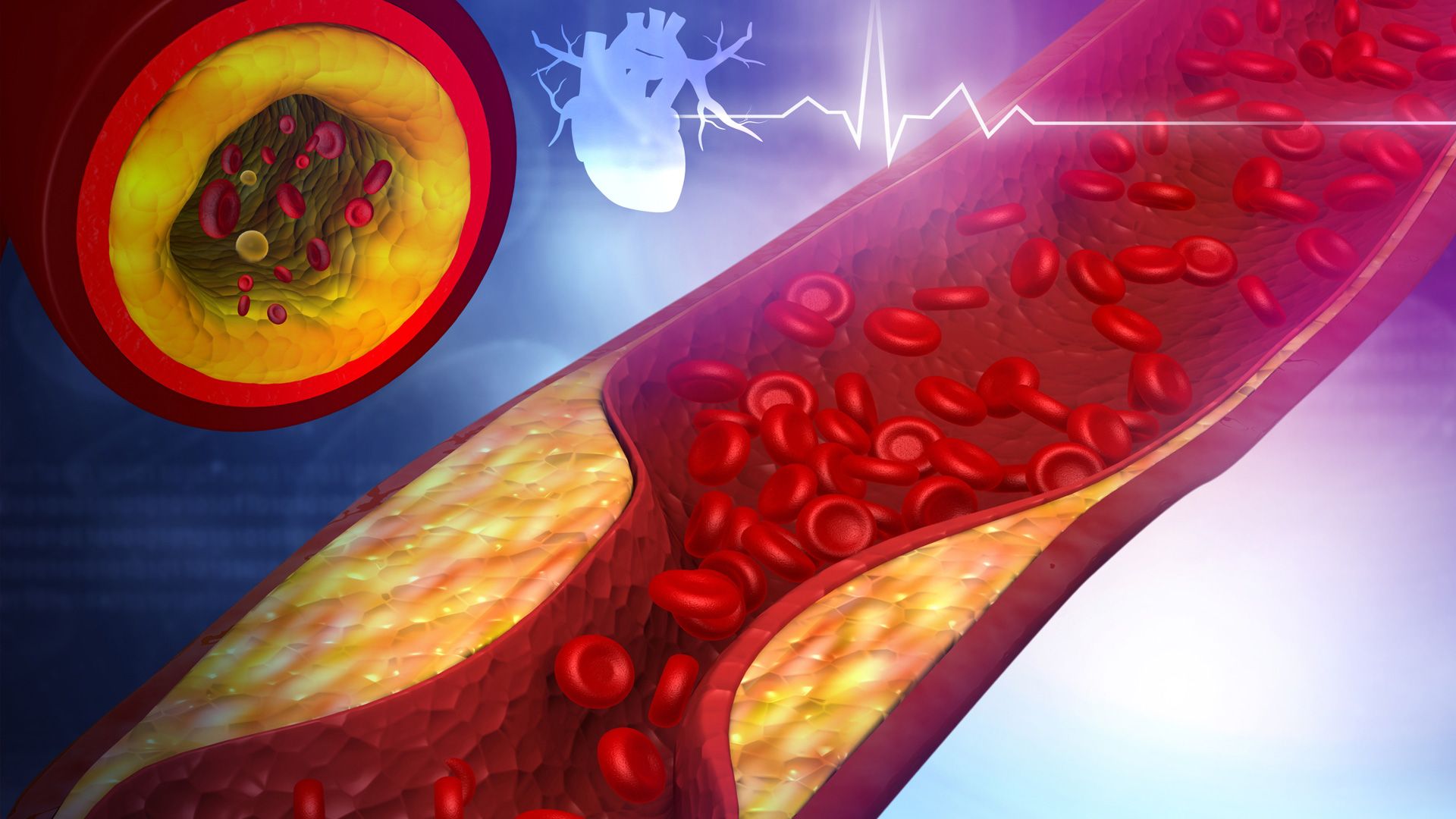 Dyslipidemia 