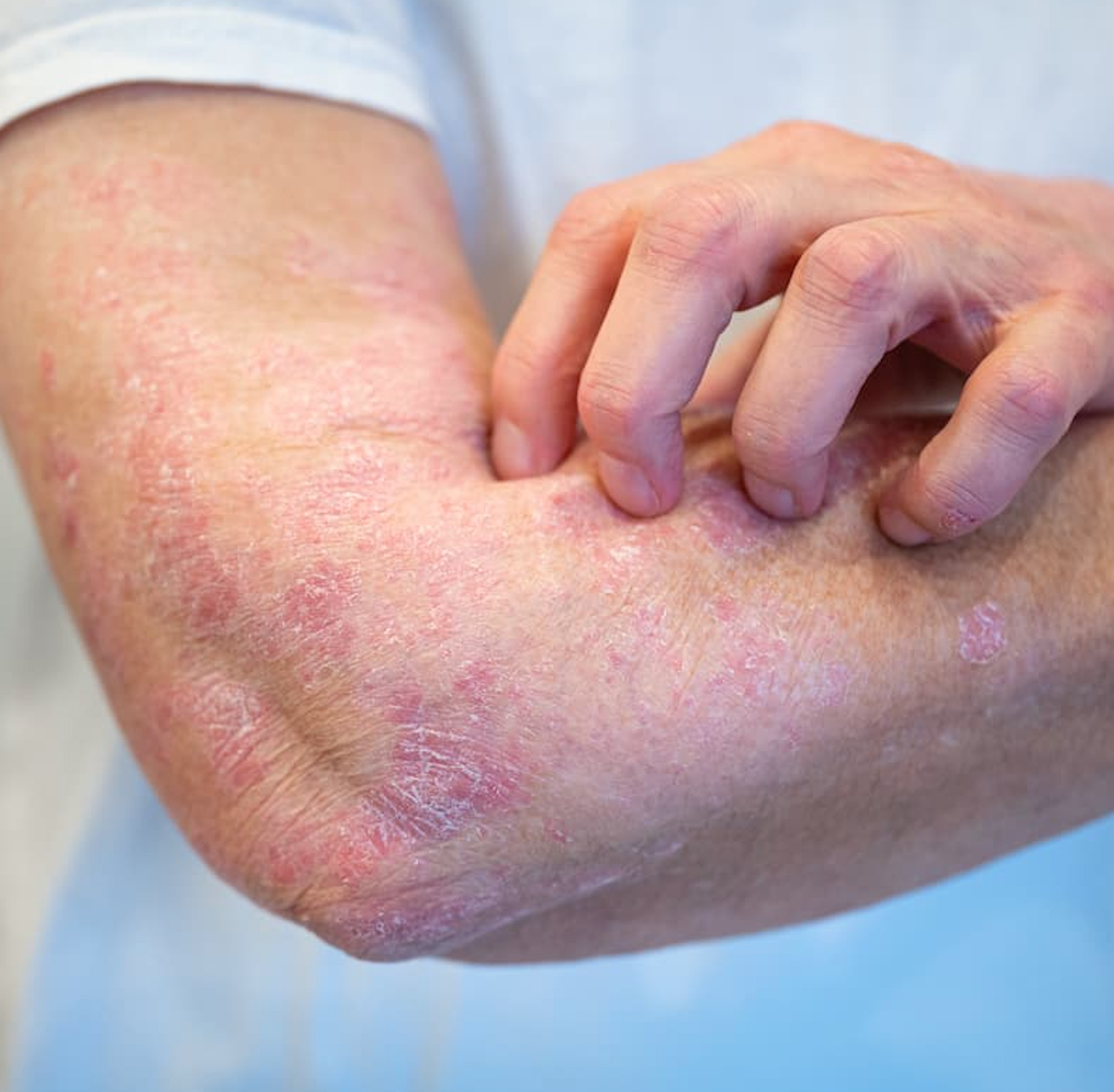 Linda Stein Gold, M.D., on How Guselkumab Targets Psoriasis