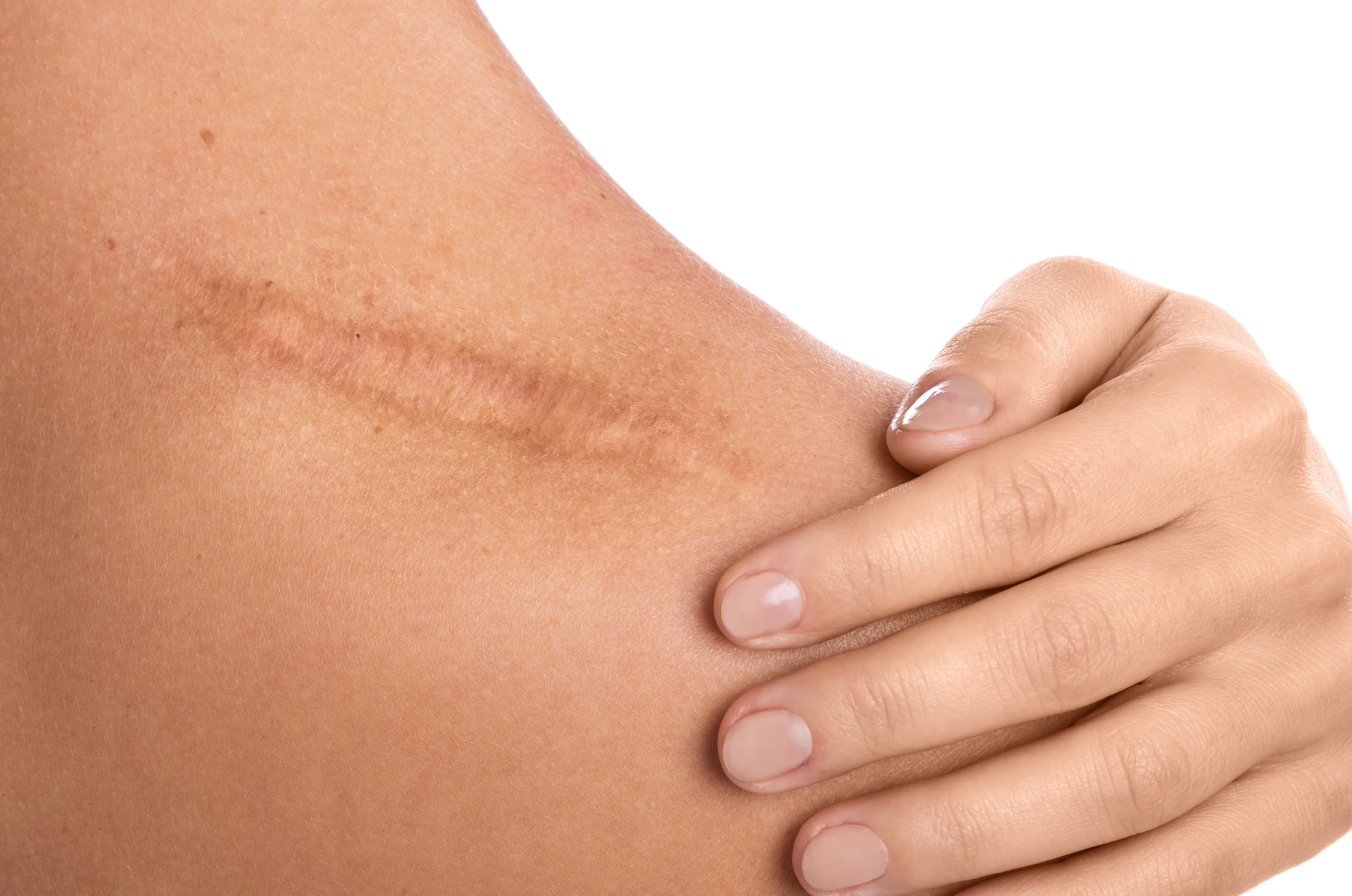 Scars That Stay: How Skin Health Impacts Mental Health