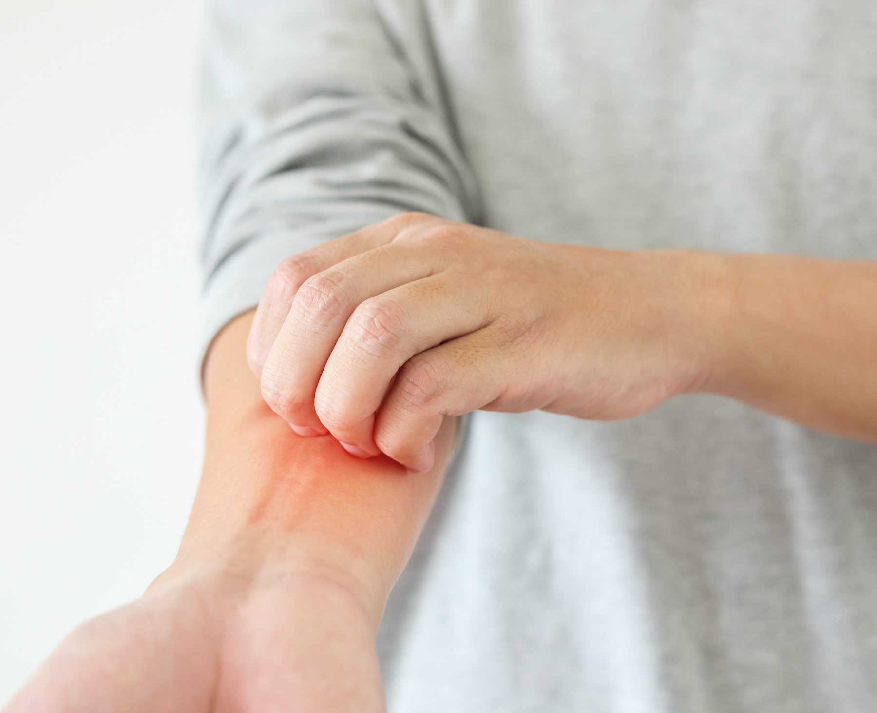 How Sarah Harris Found Power in Her Eczema Story