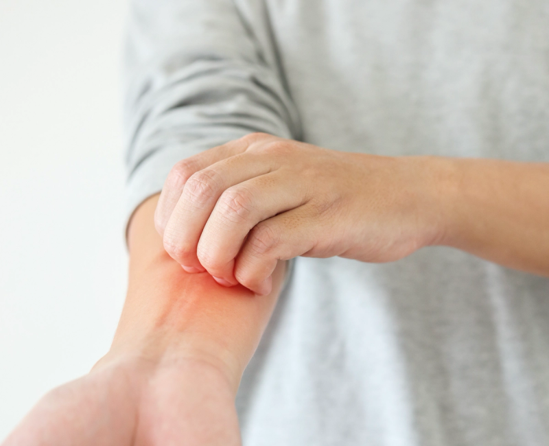 How Sarah Harris Found Power in Her Eczema Story