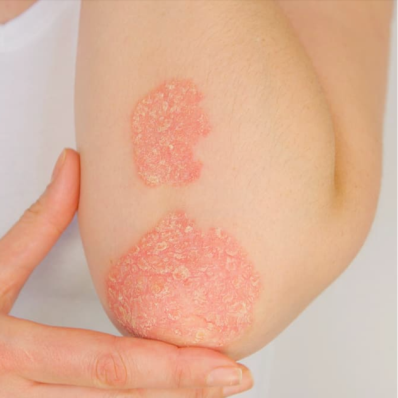Uwe Gudat, M.D.: New Biosimilar Data Bring Reassurance for Patients With Psoriasis