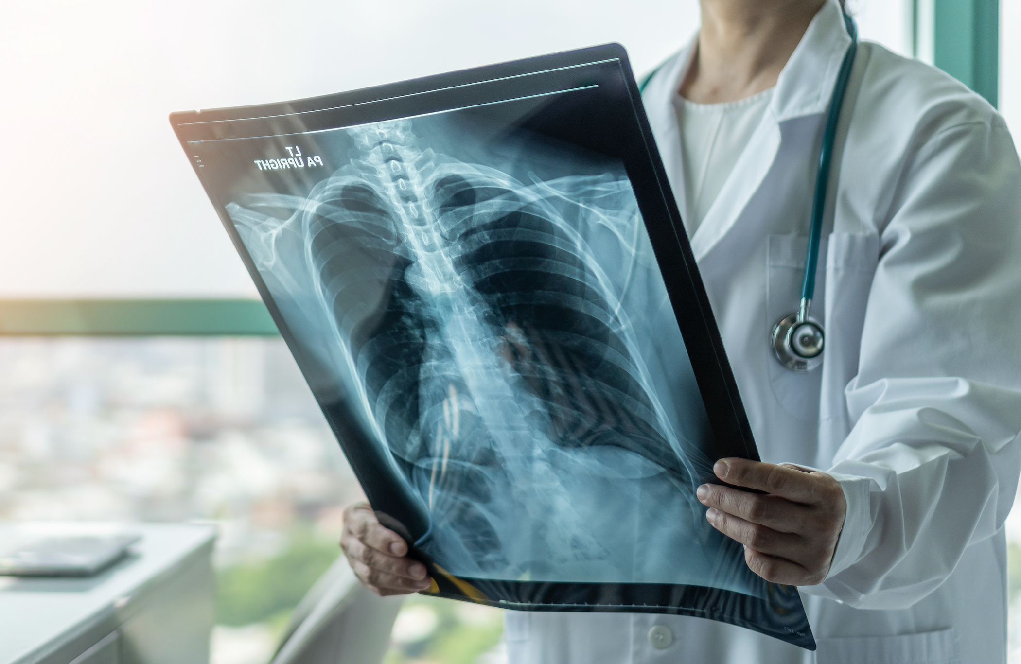 Catching Cancer Early: New Tools Support Patients With Lung Nodules