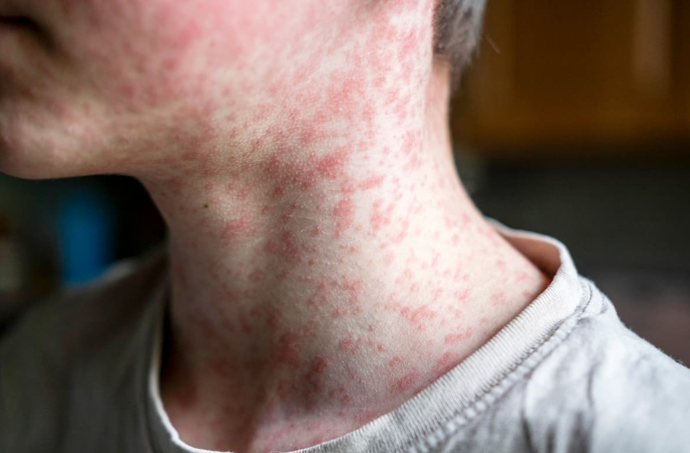 Measles Cases Are Climbing in the U.S. Here's What's Driving It. 