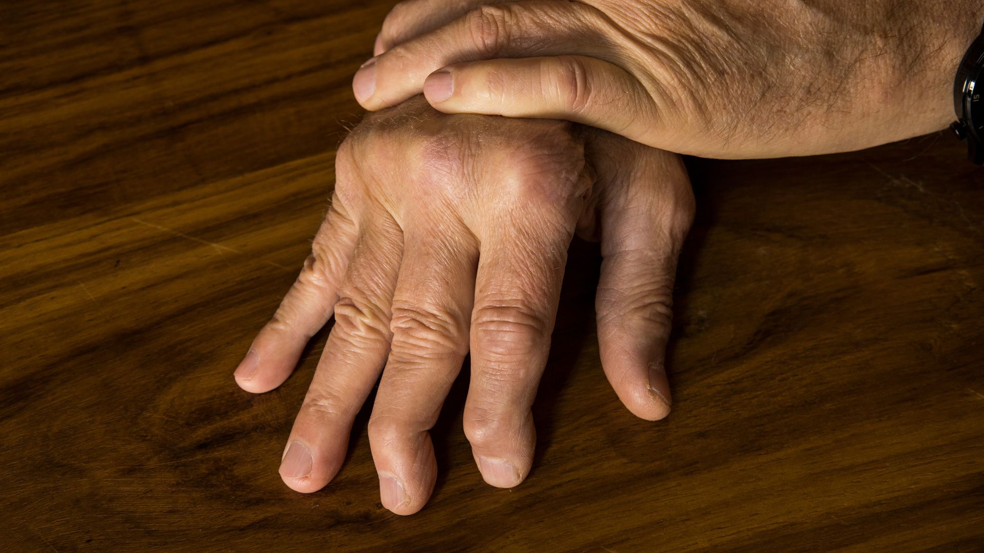 Psoriatic Arthritis