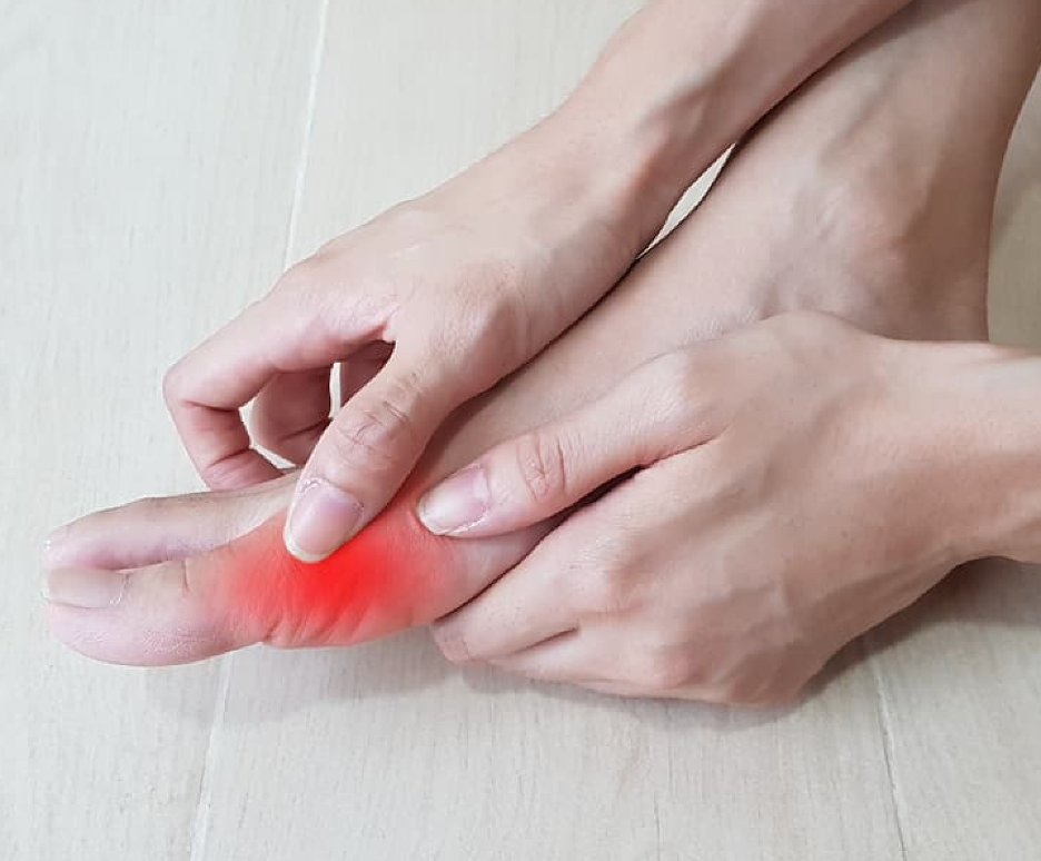 Why Standard Gout Treatments Might Not Work for You 