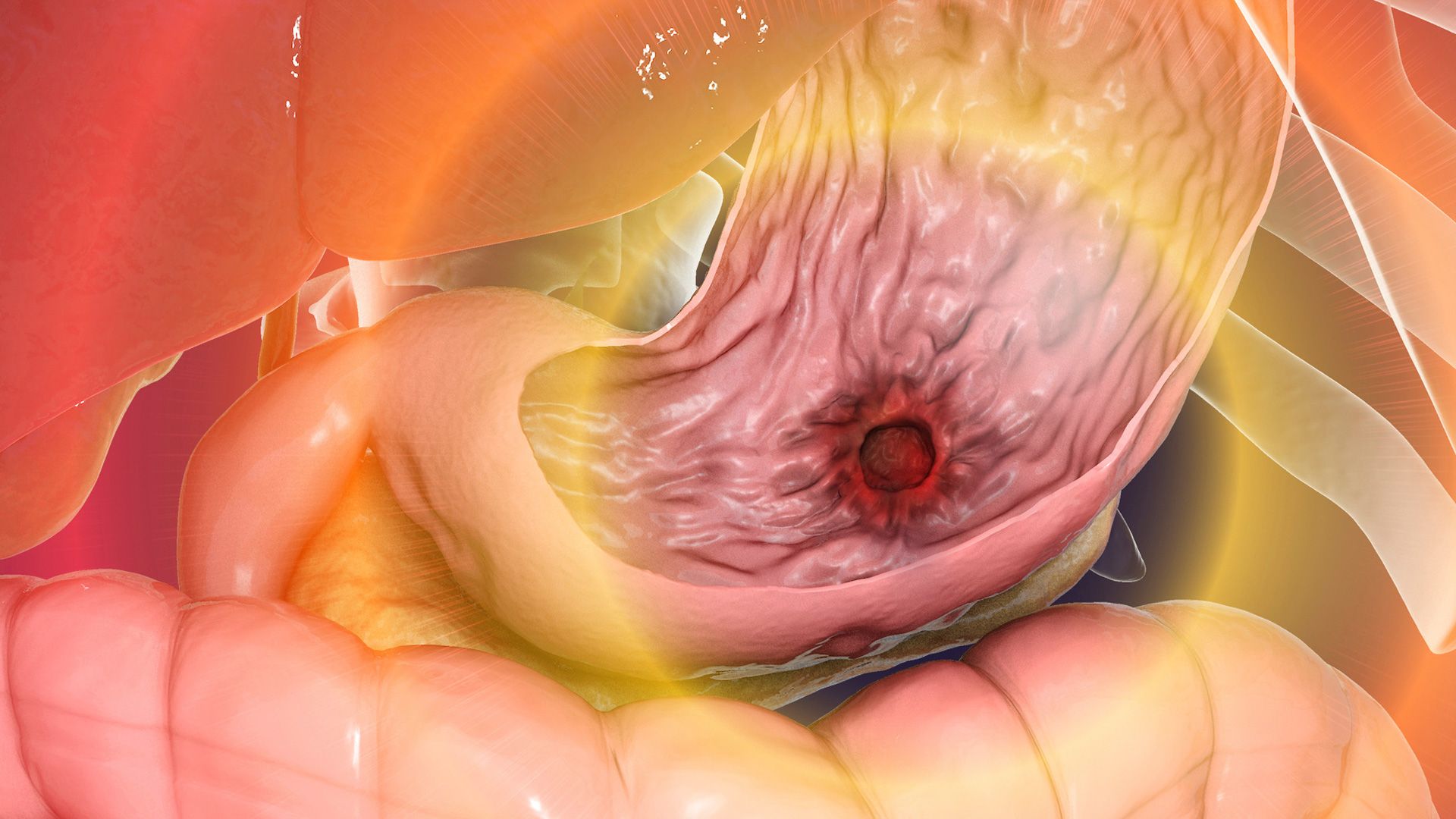 Peptic Ulcer 