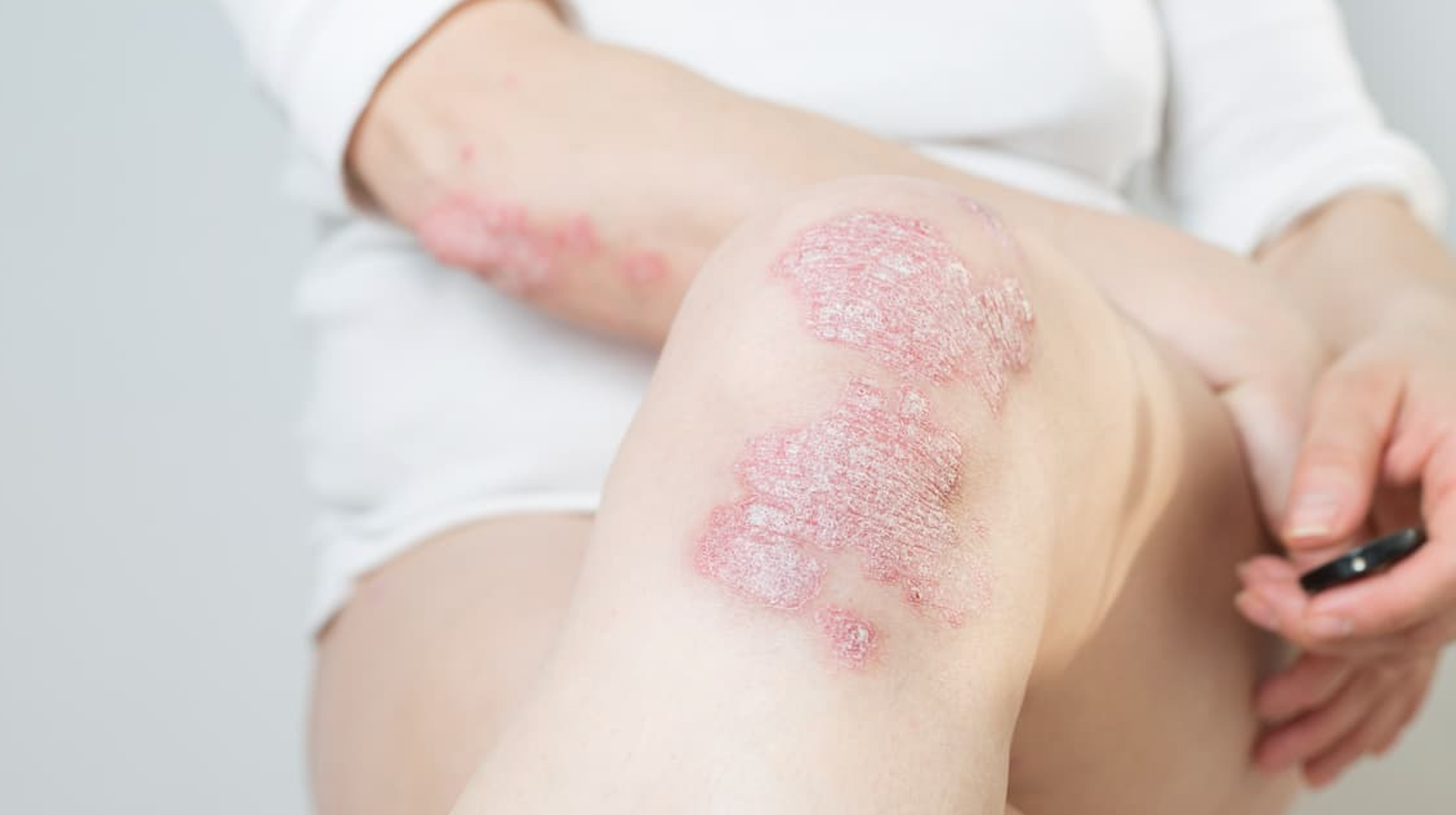 A Once-Daily Pill for Hard-to-Treat Psoriasis Holds Up Over Two Years