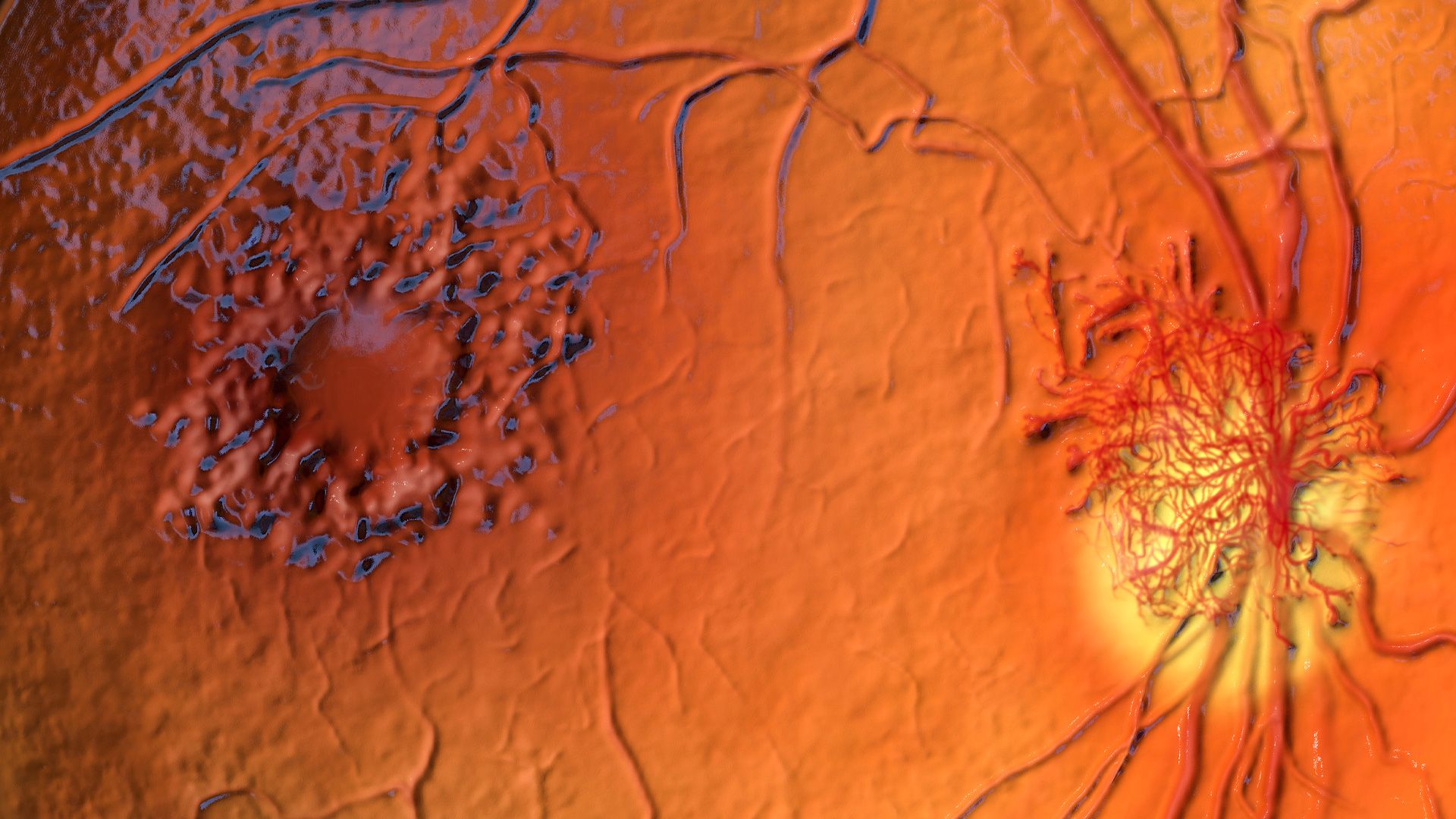 Diabetic Retinopathy