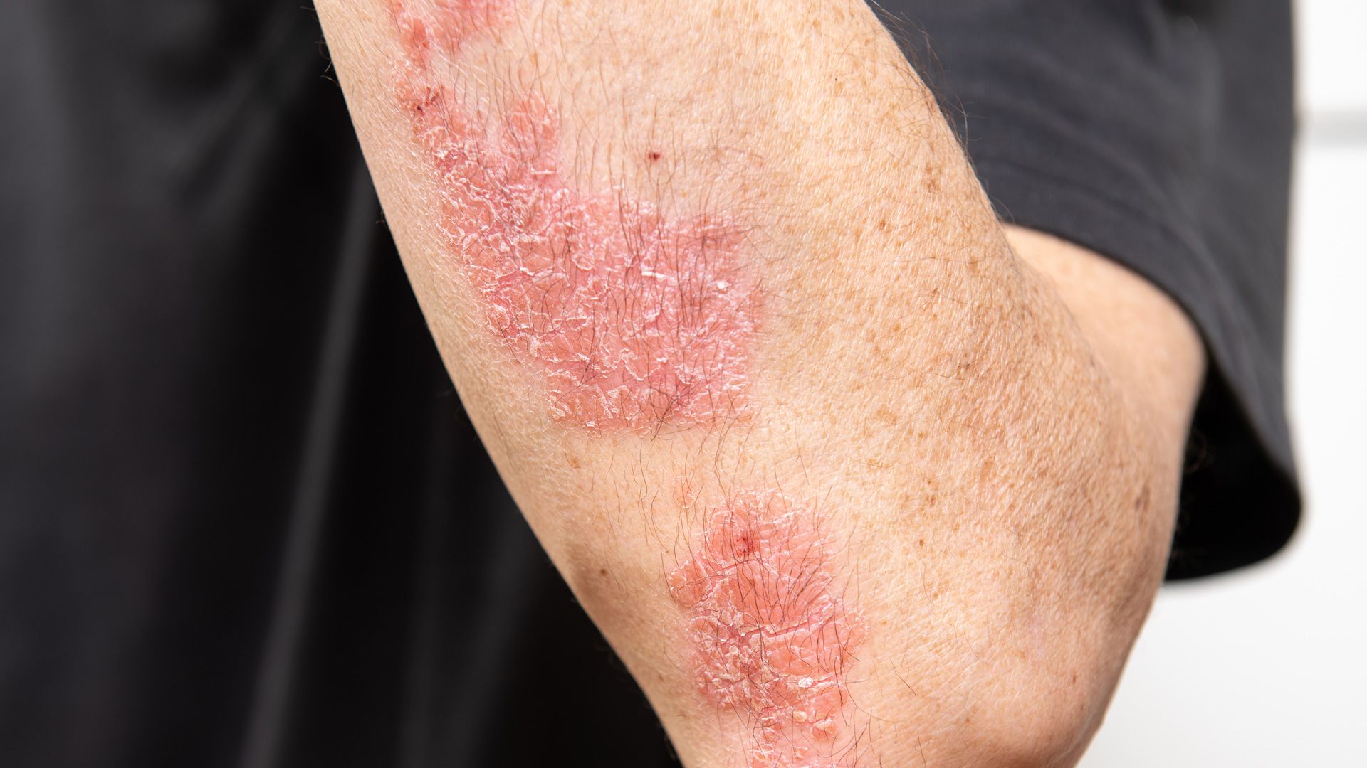 Plaque Psoriasis 