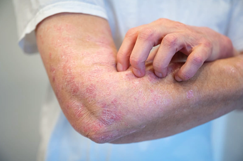 FDA Approves Icotrokinra, the First Targeted Oral Treatment for Moderate to Severe Plaque Psoriasis