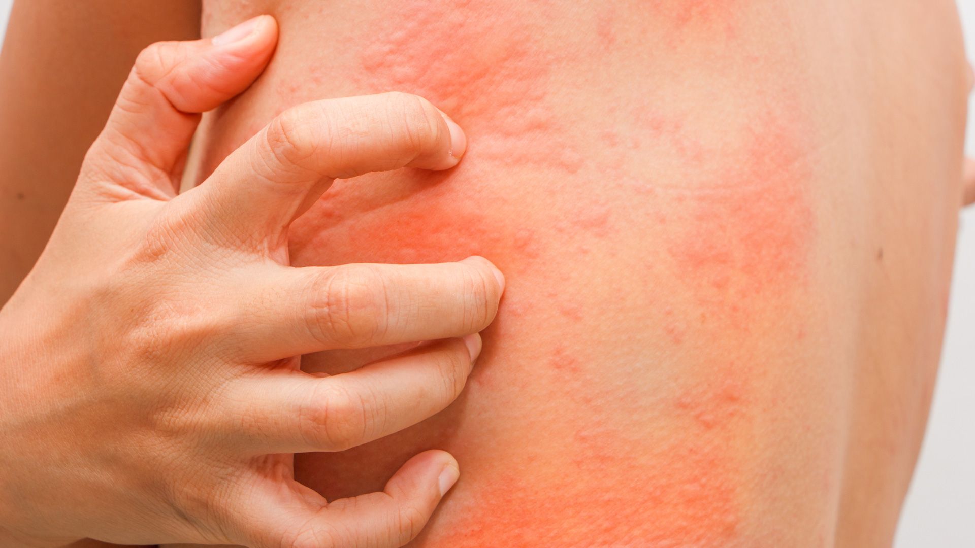 Chronic Idiopathic Urticaria 