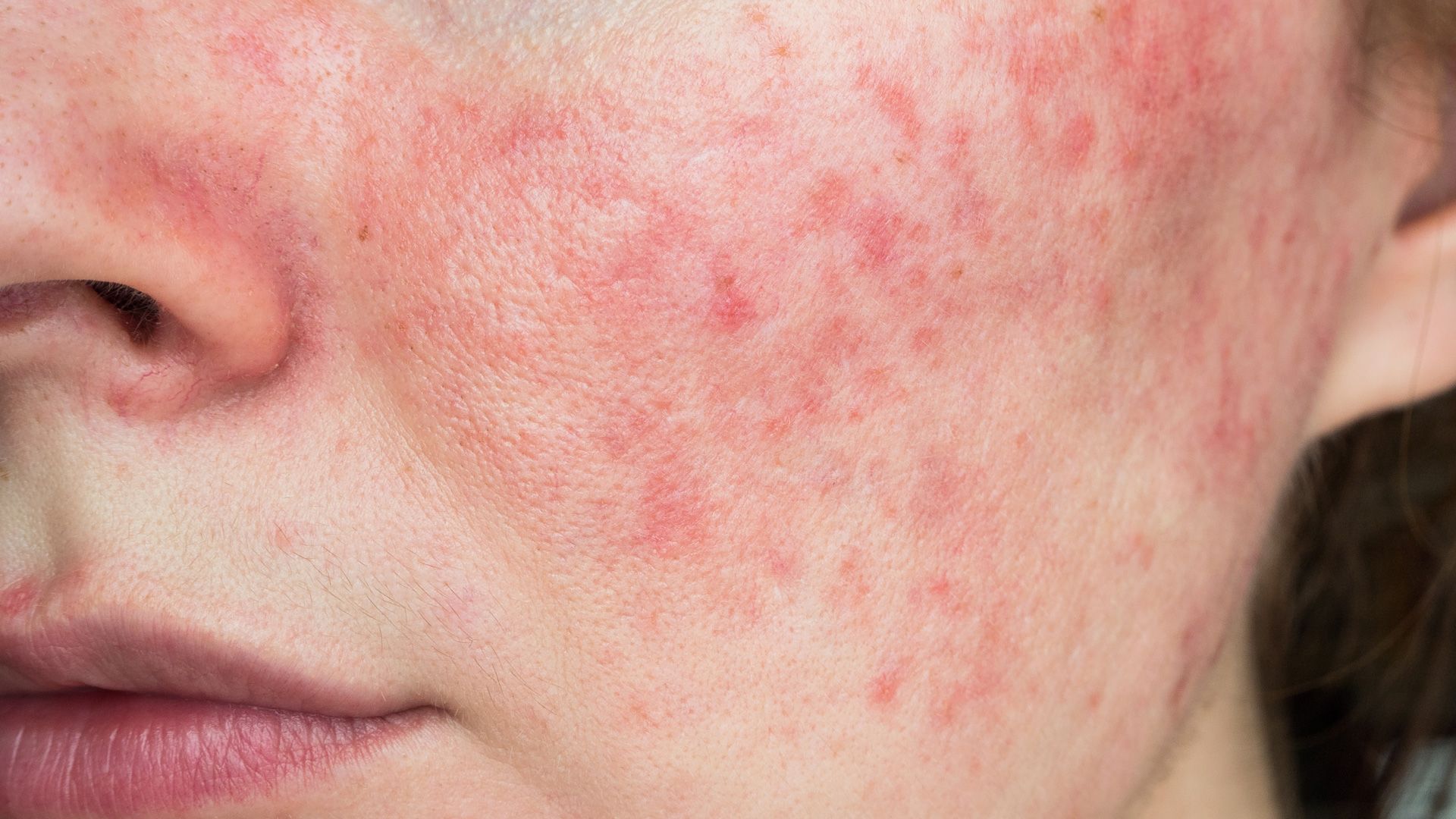 Rosacea 