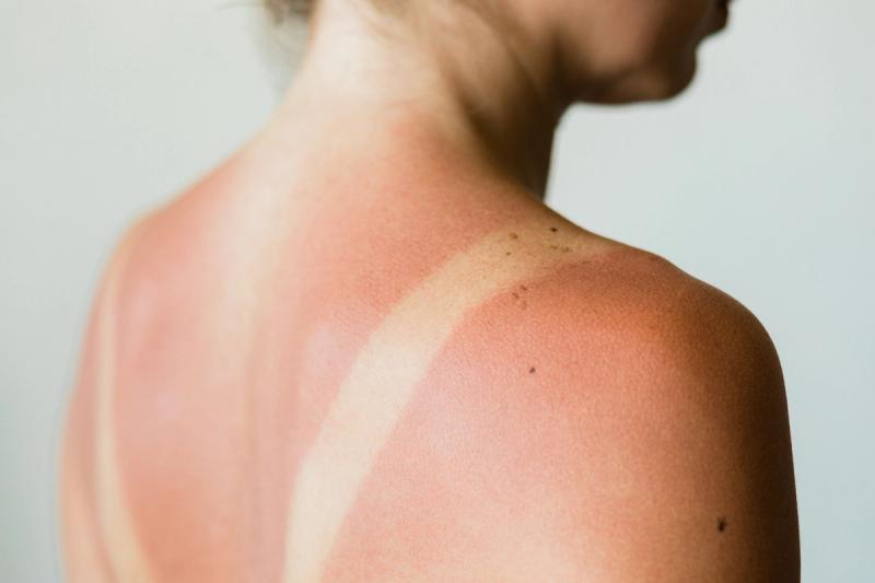 Close-up of a sunburn marks on a woman's back | Credit: Adobe Stock