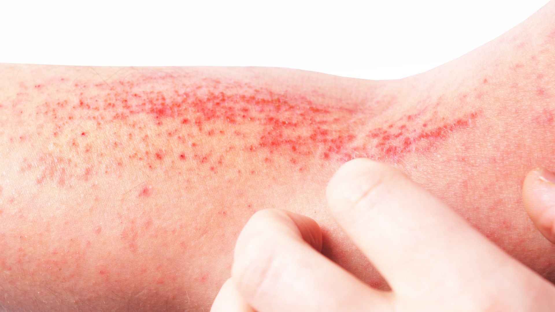 Atopic Dermatitis