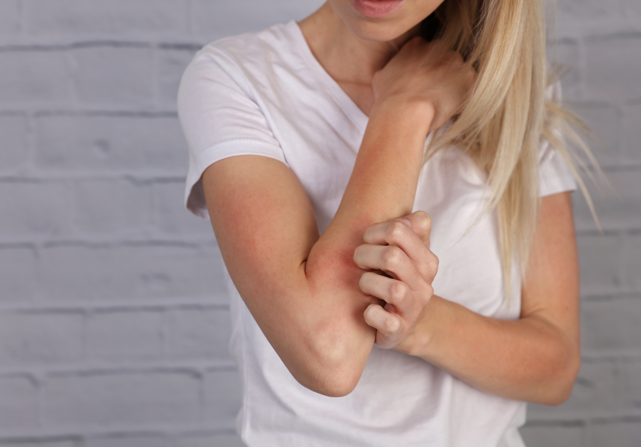 More Options, Less Stigma for People With Eczema