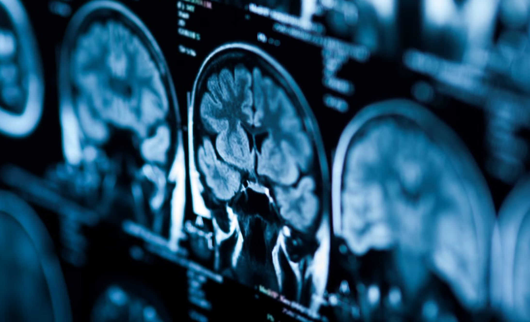 Alzheimer’s Risk Isn’t the End of the Story — It’s the Beginning