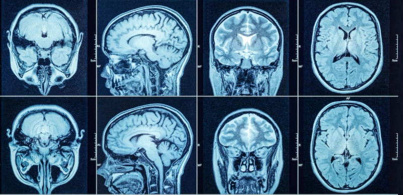 The Brain’s Flexibility May Hold the Key to Understanding Mental Illness in a Whole New Way