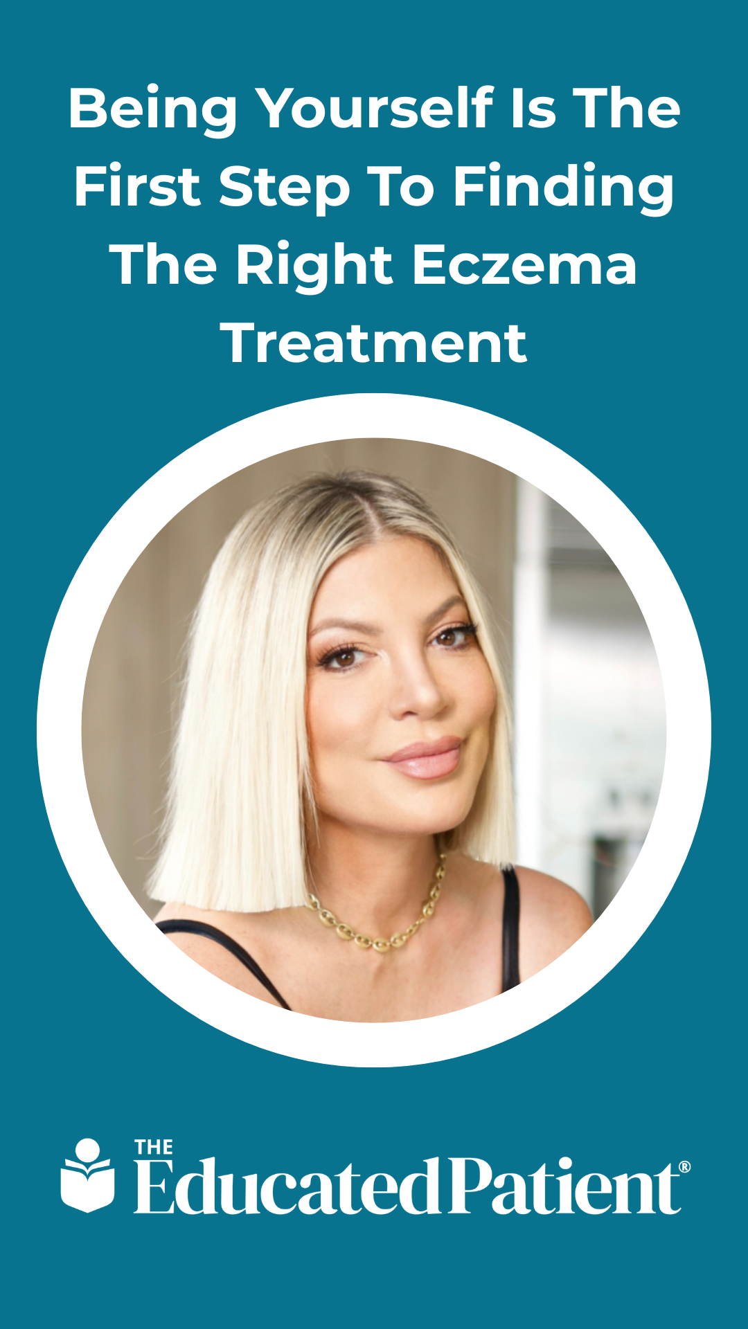 Being Yourself Is The First Step To Finding The Right Eczema Treatment