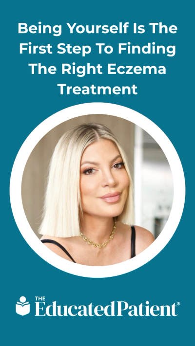 Being Yourself Is The First Step To Finding The Right Eczema Treatment