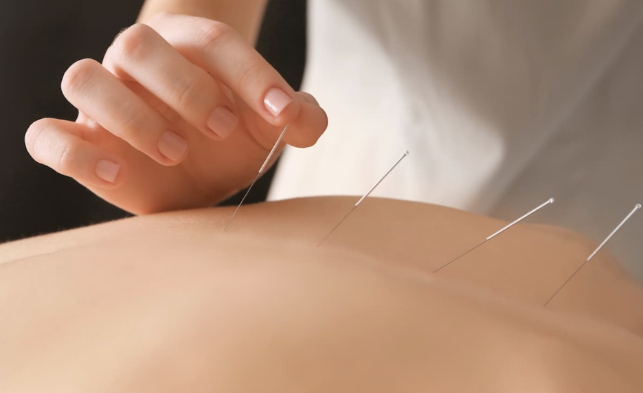 Acupuncture May Improve Cognitive Symptoms in Breast Cancer Survivors