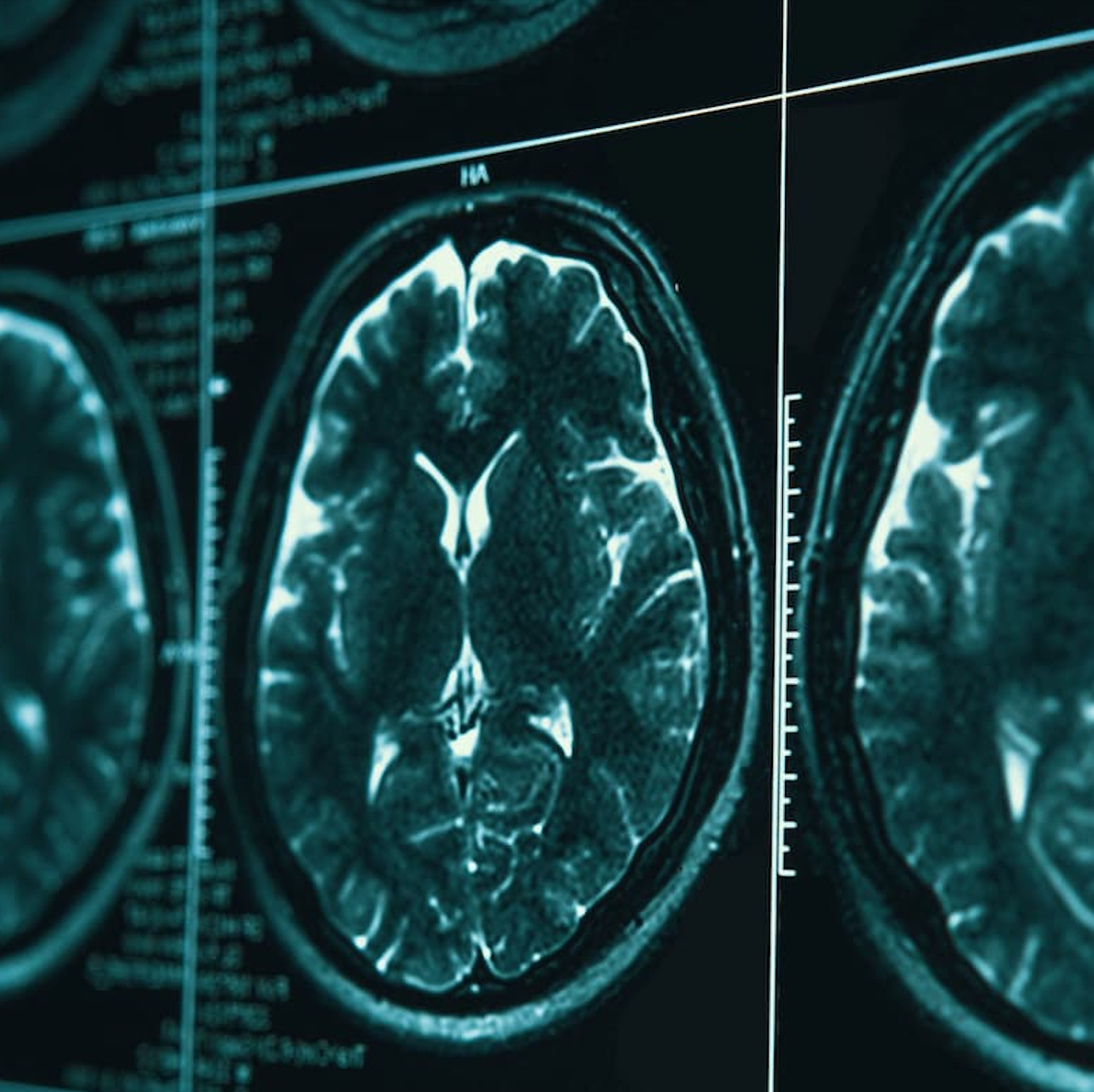 Cazoshay Marie on Surviving and Thriving with a Traumatic Brain Injury