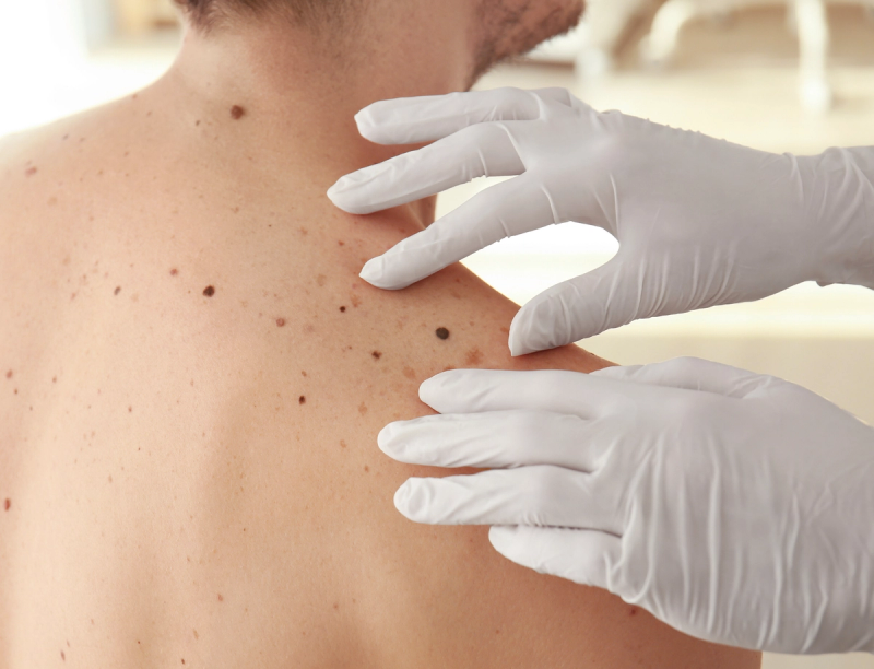 A Skin Cancer Journey That Changed Everything