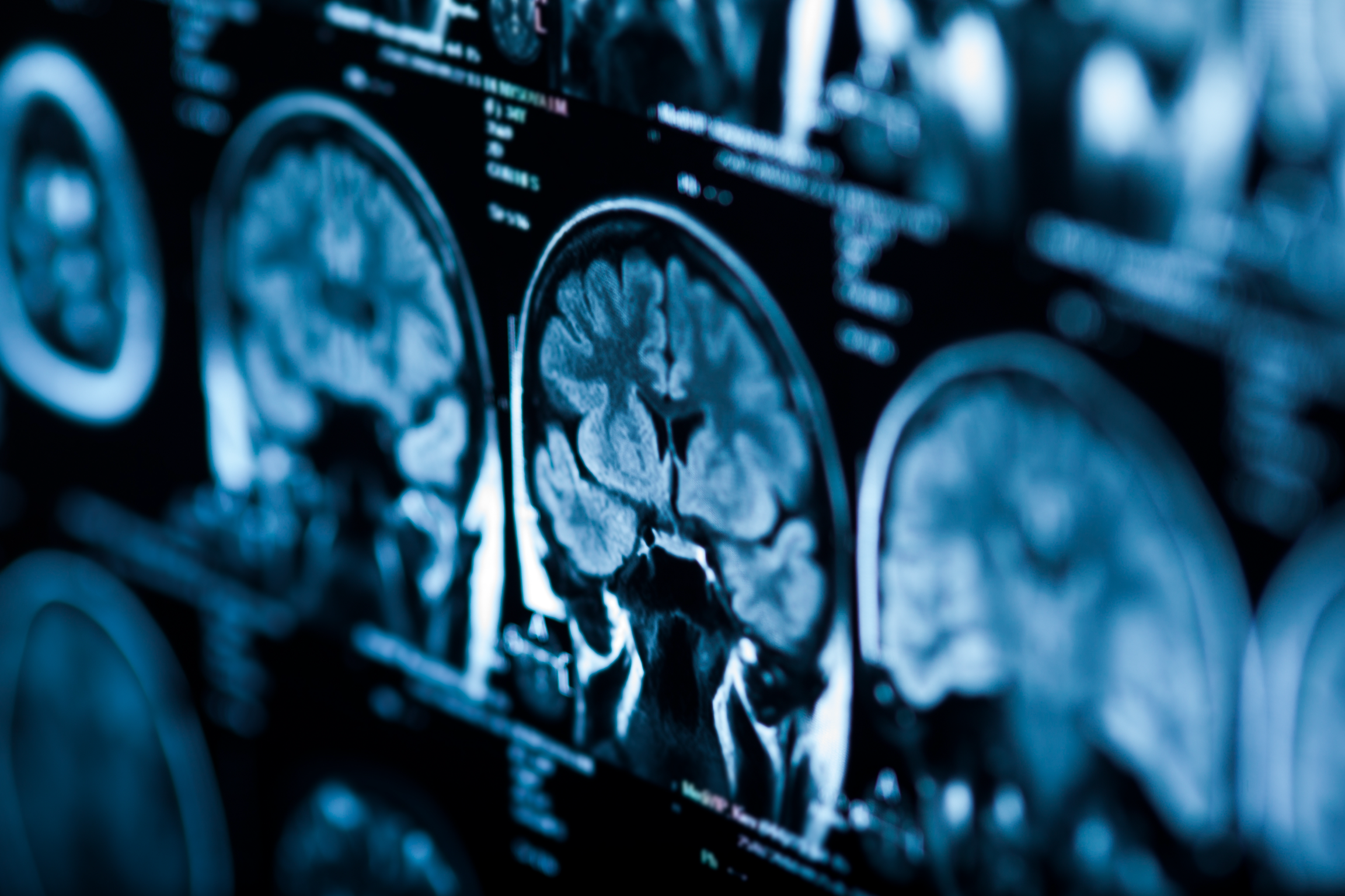 Hear My Journey: From Neuro ICU Nurse to Brain Aneurysm Survivor