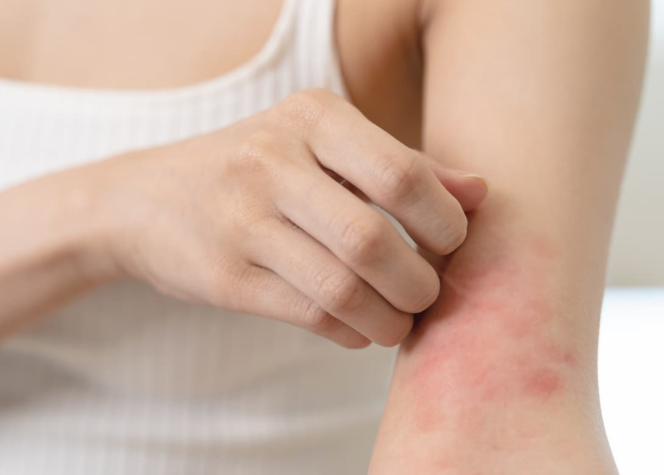 Survey Reveals Gaps in Long-Term Care for Eczema, Psoriasis and Seborrheic Dermatitis