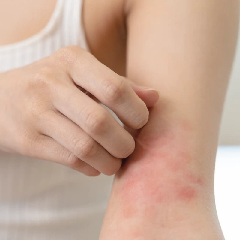 7 Summer Skin Conditions You Might Mistake for Eczema