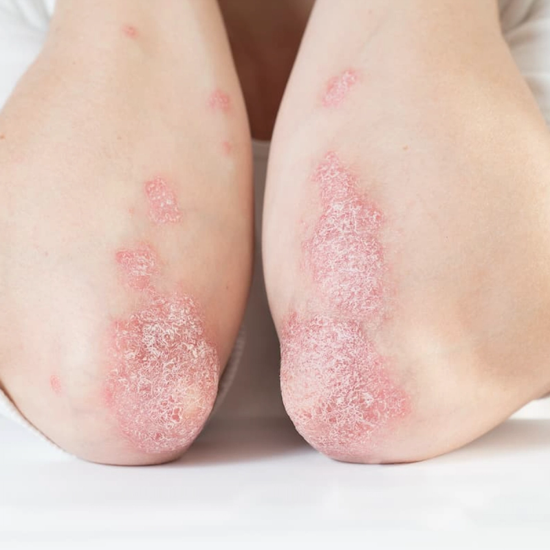 Why Residual Inflammation Matters in Psoriasis Care