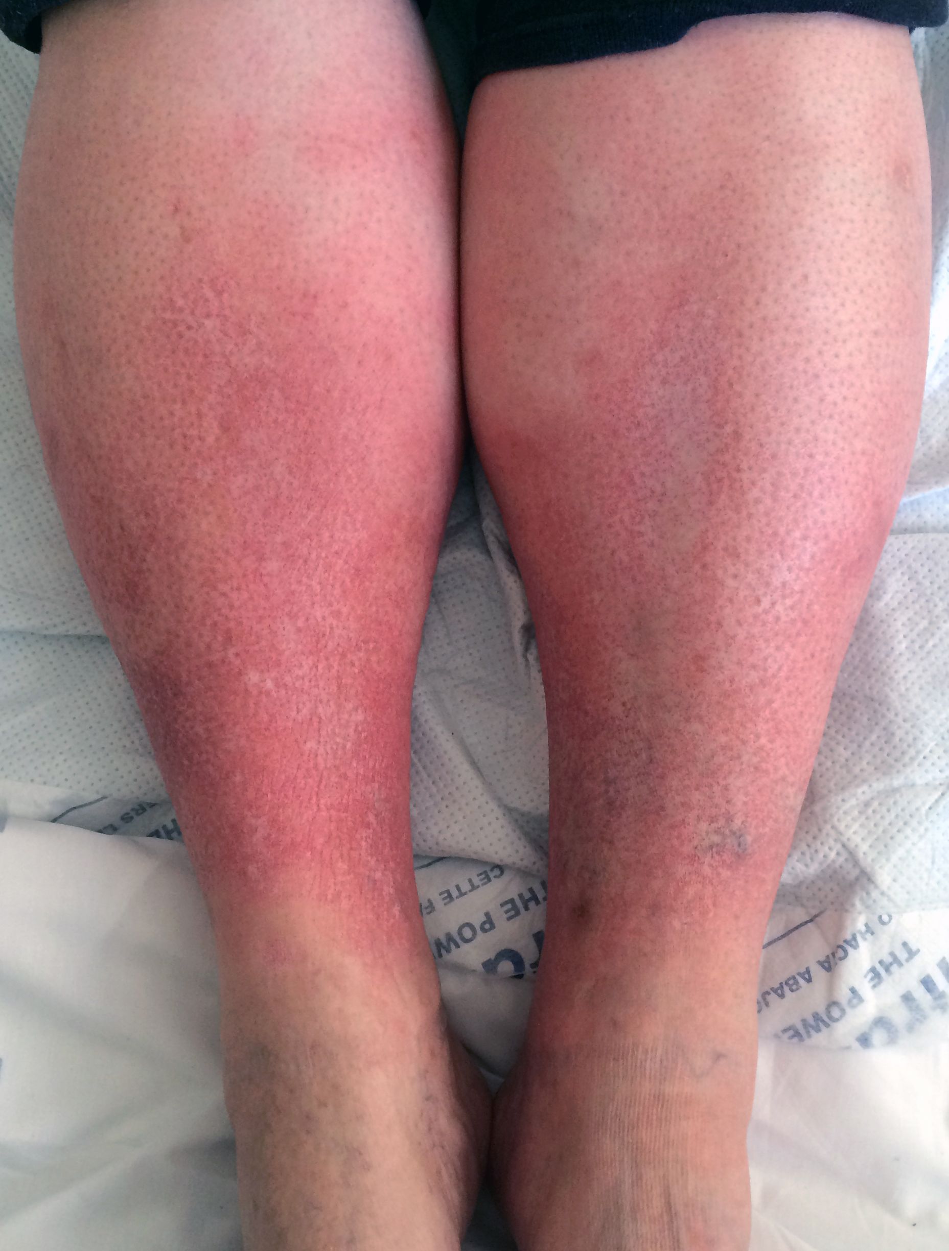 Ce este dermatita varicoasă (lipodermatoscleroza) și cum să o vindecați