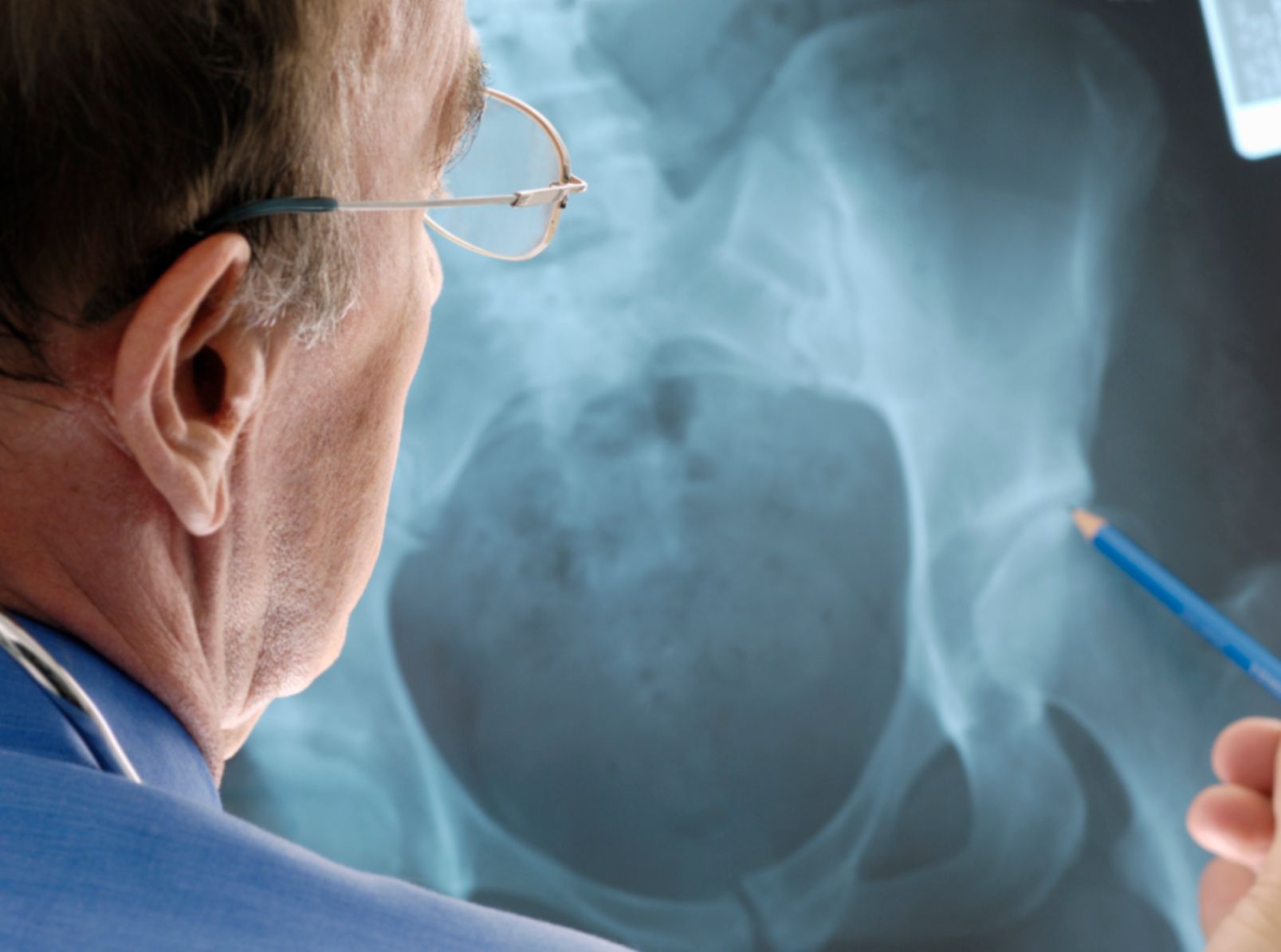 hip fracture x-ray