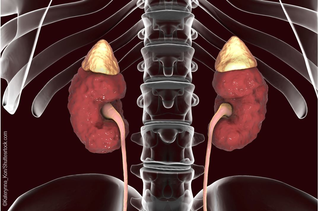 pheochromocytoma-quiz-what-s-your-pheo-iq-endocrinology-network