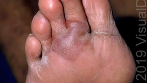 bullosis diabeticorum pathophysiology a kezelés népi jogorvoslati üszkösödés láb cukorbetegség