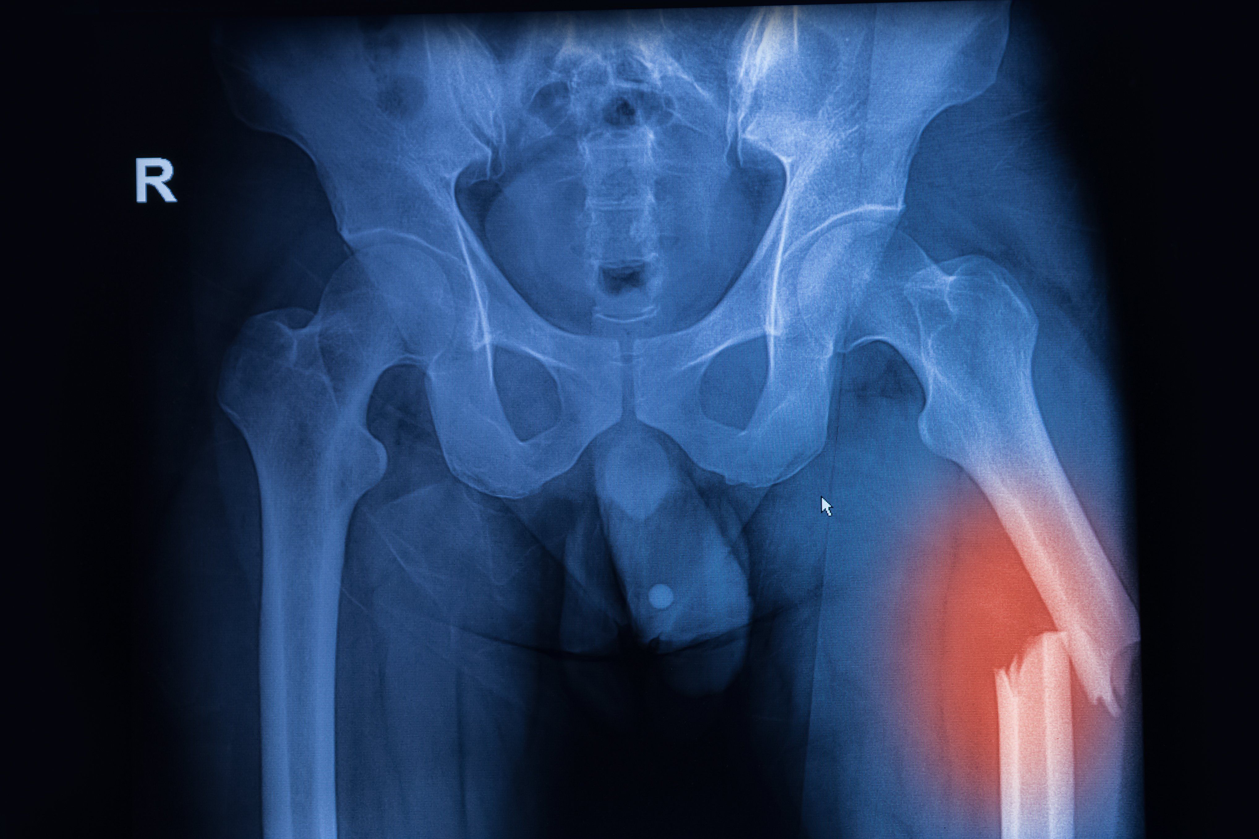 Перелом тазобедренного сустава рентген