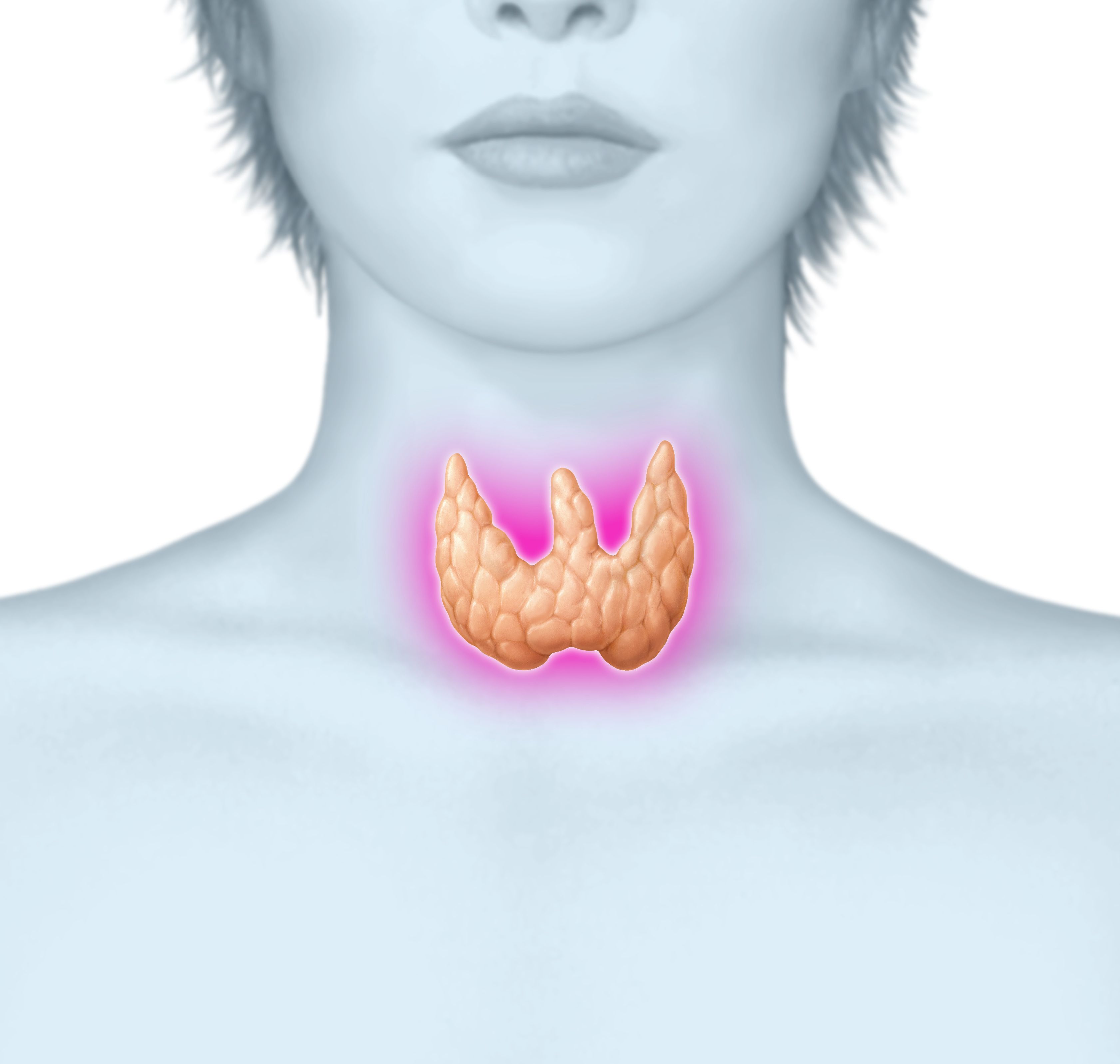 Йод при заболевании щитовидной. Токсическая аденома щитовидной железы. Струма щитовидной железы.