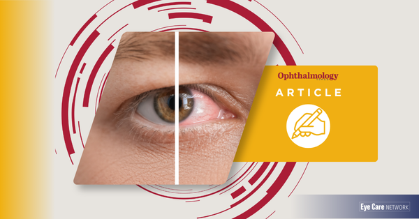 Aldeyra to appeal FDA rejection of reproxalap as a treatment for dry eye disease
