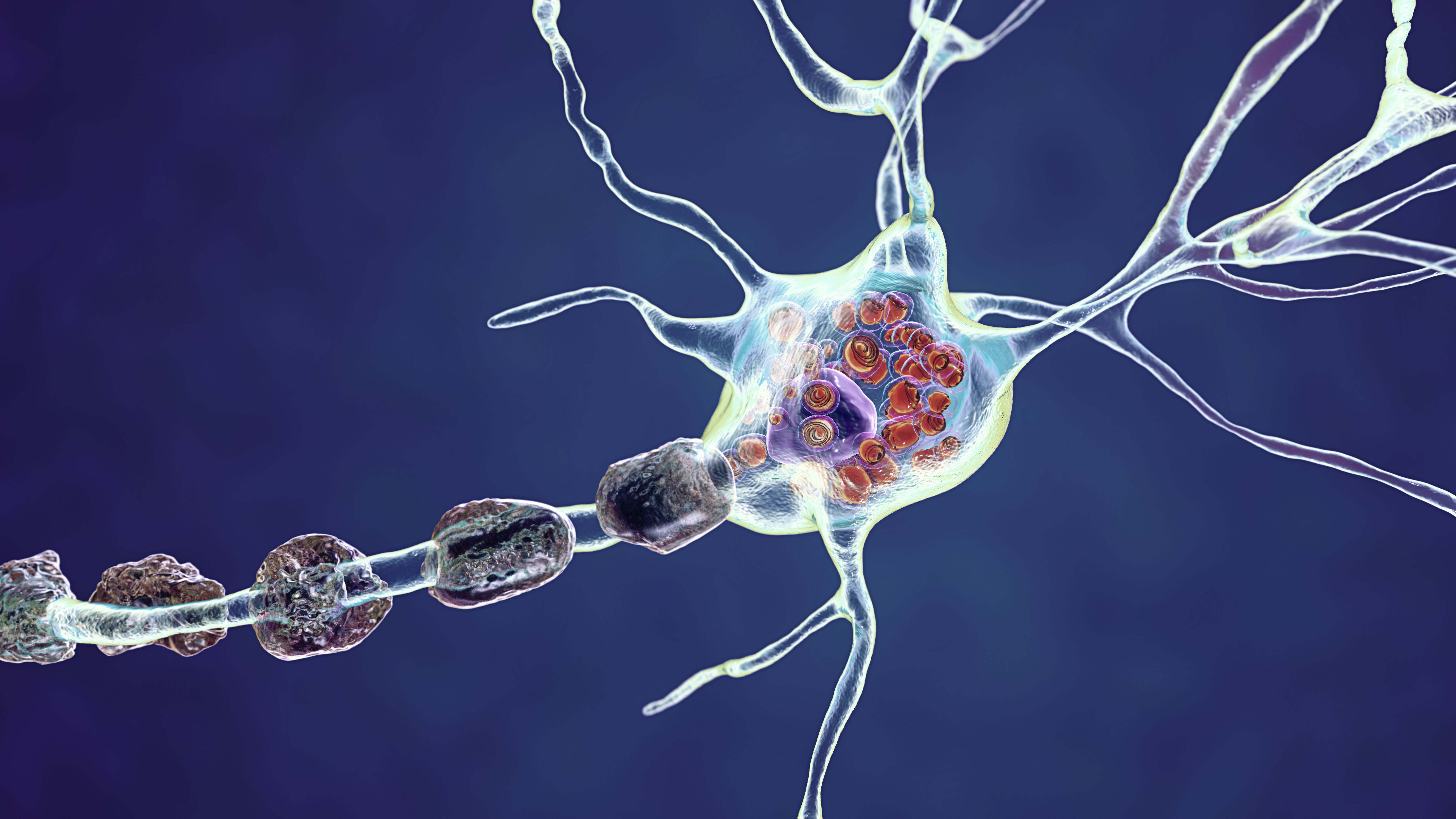 Giant Axonal Neuropathy in the News - Hannah’s Hope Fund