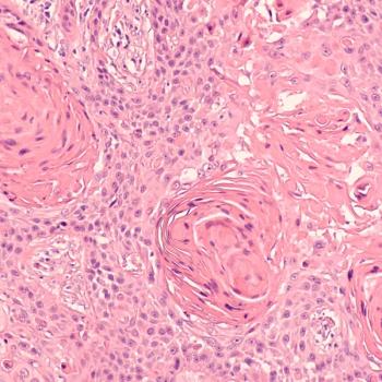 Biological Immunotherapy Combo Improves Survival in Patients With NSCLC