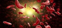 Genome-Edited Cell Therapy Reduces VOEs in Sickle Cell Disease 